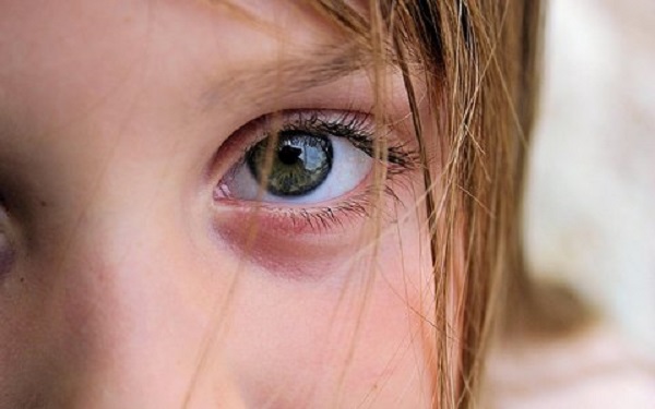 Ячмень на глазу у ребенка лечение