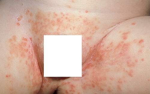 Пеленочный дерматит у детей фото