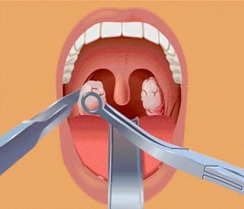 Как удаляют аденоиды у детей через рот