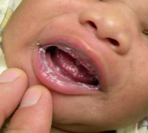 Молочница у детей во рту фото