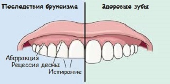 Последствие скрежета зубов