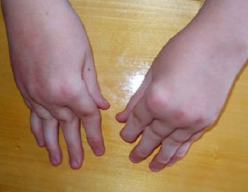 Ювенильный ревматоидный артрит у детей лечение