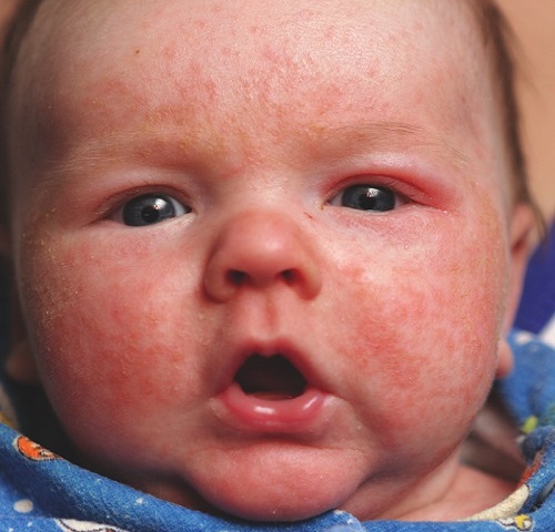 Атопический дерматит у детей до года