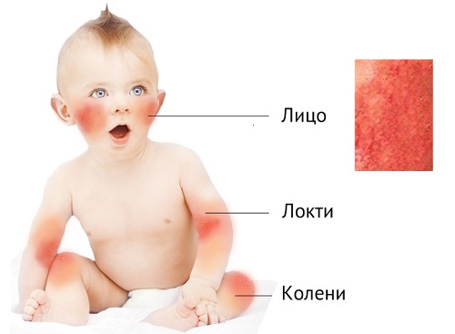 Атопический дерматит у детей симптомы