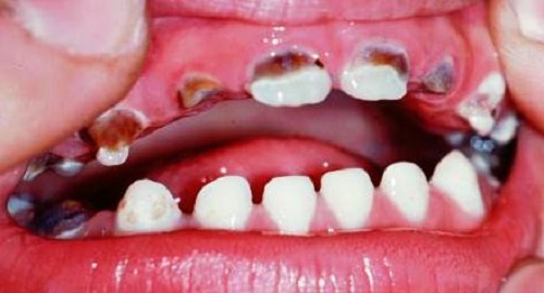 Кариес молочных зубов симптомы