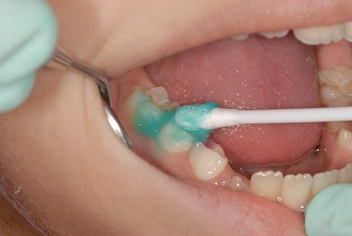 Реминерализация зубов у детей