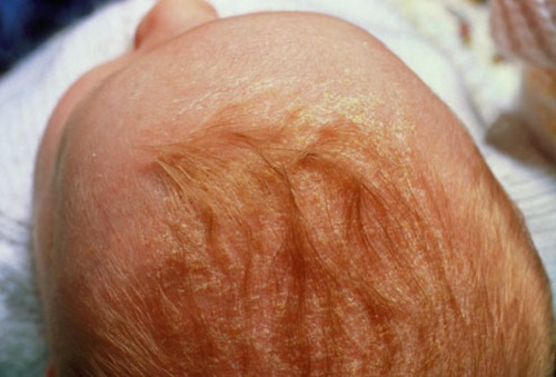 Себорея на голове при атопическом дерматите у детей