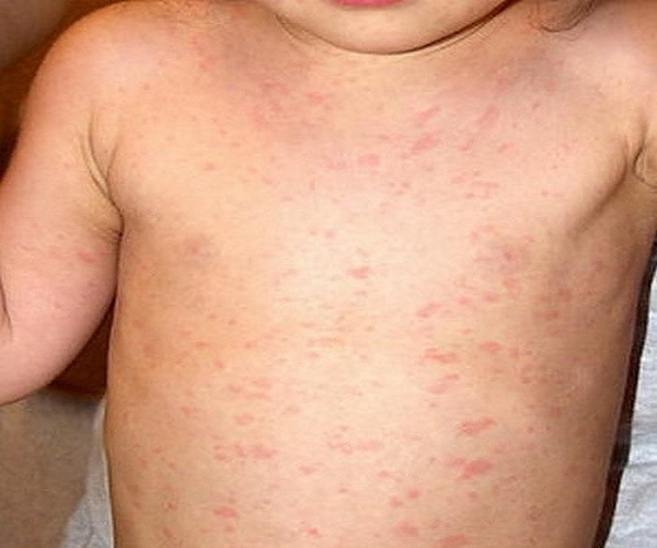 Фото вируса герпеса 6 типа у ребенка