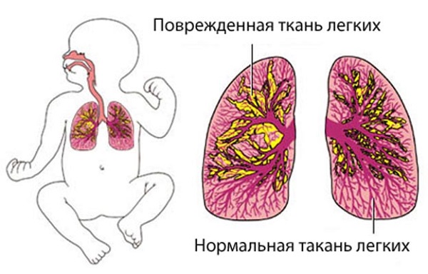 Пневмония у детей симптомы