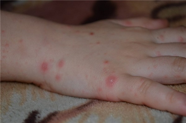 Аллергия на антибиотик у детей фото