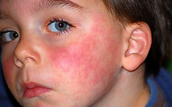 Аллергия на солнце у детей фото