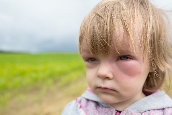 Аллергия на солнце у детей отек Квинке