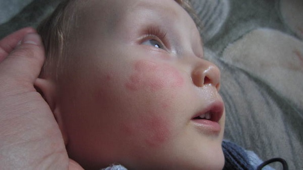 Аллергия на холод у ребенка причины