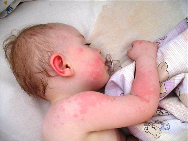 Аллергия на холод у ребенка симптомы