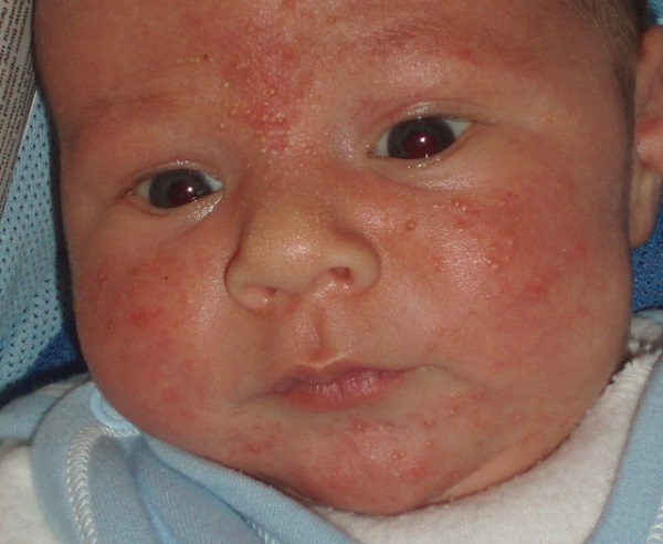 Аллергия на молоко у ребенка фото