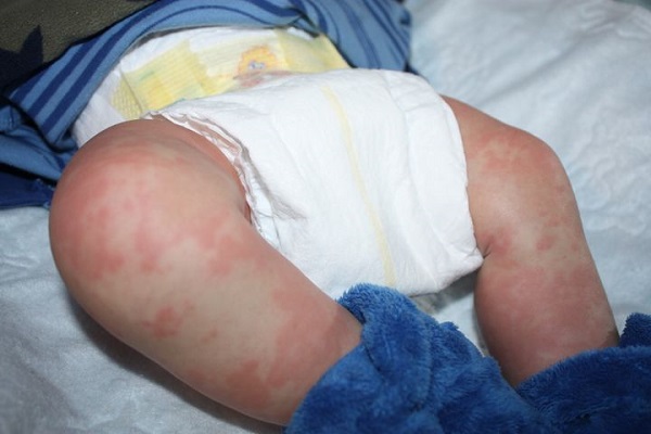 Аллергия на памперс