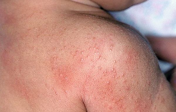 Аллергия на сладкое у ребенка фото