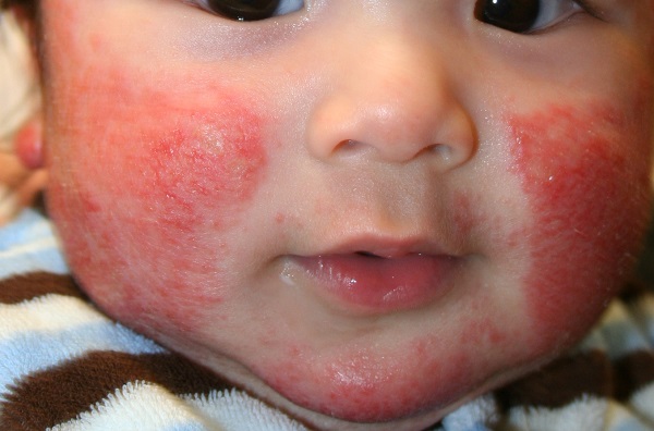Аллергия на сладкое у детей фото