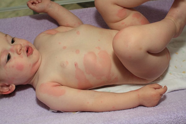 Аллергия на яблоки у ребенка фото