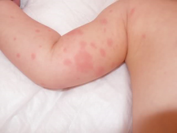Аллергия на яйца у ребенка симптомы фото
