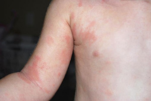 Пищевая аллергия у детей фото