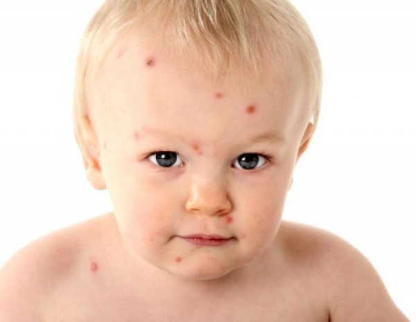 Пищевая аллергия у детей симптомы