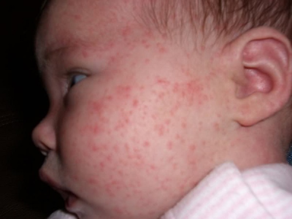 Пищевая аллергия у ребенка фото