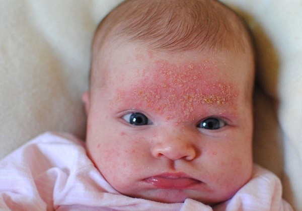 Аллергический дерматит у детей фото