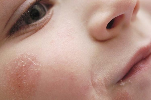 Контактный дерматит у детей фото