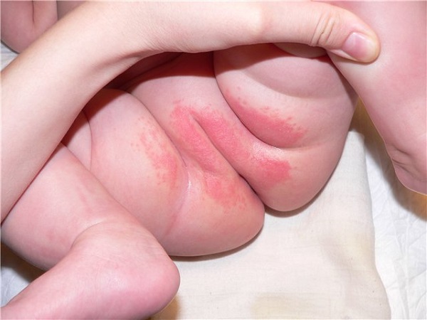 Контактный дерматит у детей причины