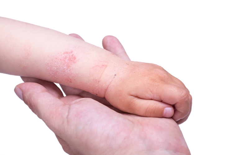 Аллергическая сыпь у детей: причины возникновения, разновидности и фото