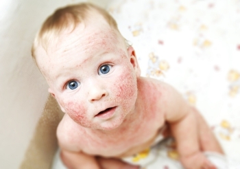 Аллергическая сыпь у детей: причины возникновения, разновидности и фото
