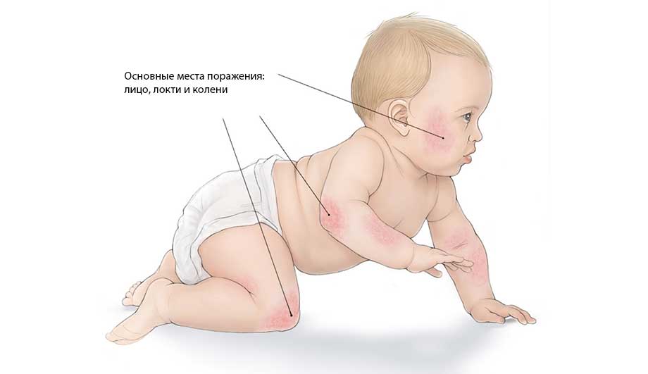 Атопический дерматит у детей: симптомы, лечение и профилактика
