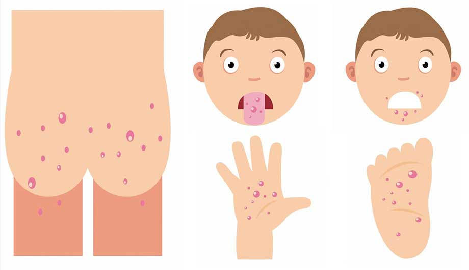 Коксаки вирус у детей: симптомы, лечение, профилактика