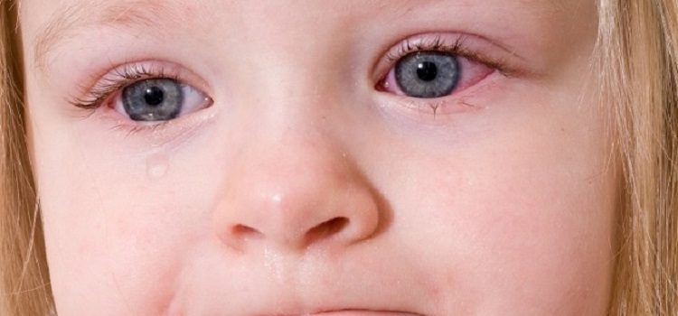 Красные глаза у ребенка: всегда ли это признак аллергии?