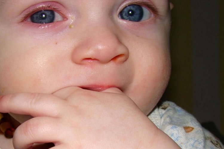 Красные круги, мешки под глазами у ребенка, покраснели верхние или нижние веки: насколько опасны такие симптомы?