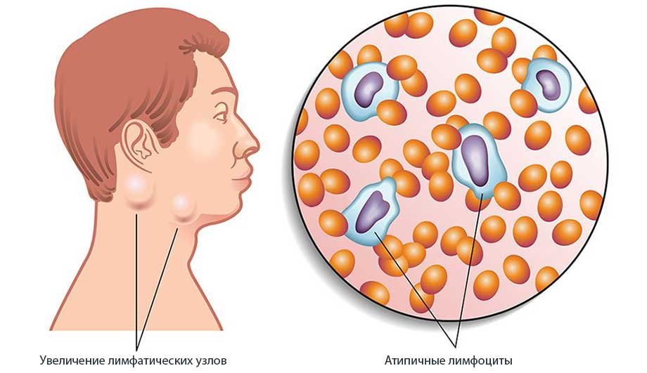 Мононуклеоз у взрослых: симптомы и лечение