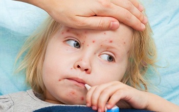 Может ли привитый ребенок заболеть корью, и какова вероятность заражения?