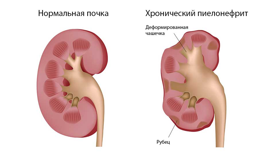 Пиелонефрит у женщин: симптомы и лечение, препараты и диета