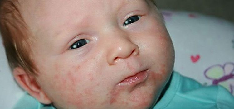 Пиодермия у детей: симптоматика и терапия в домашних условиях, внешние проявления на коже