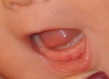 Прорезывание первых зубов у грудничков: фото десен и возможные сложности