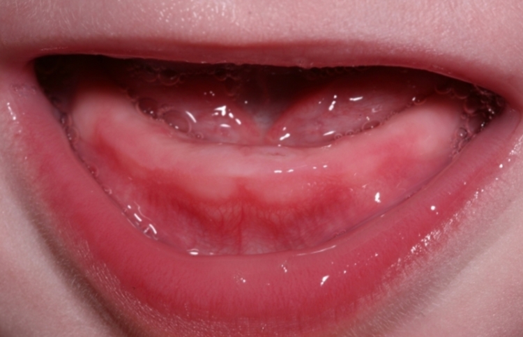 Прорезывание первых зубов у грудничков: фото десен и возможные сложности