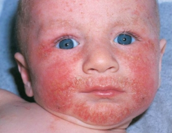 Распространенные кожные заболевания у детей: фото и описание, причины и лечение