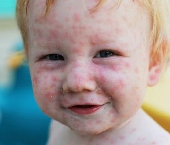 Распространенные кожные заболевания у детей: фото и описание, причины и лечение