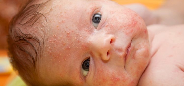 Сыпь на лице у ребенка: на какие заболевания указывает и как лечится