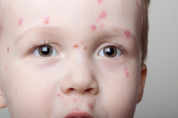 Сыпь на лице у ребенка: на какие заболевания указывает и как лечится