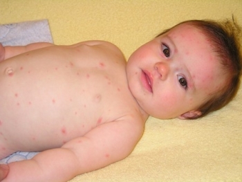 Сыпь на животе у ребенка: чем может быть вызвана и как с ней бороться