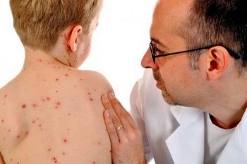 Сыпь при кори у детей (фото): как распознать главный симптом опасного заболевания?
