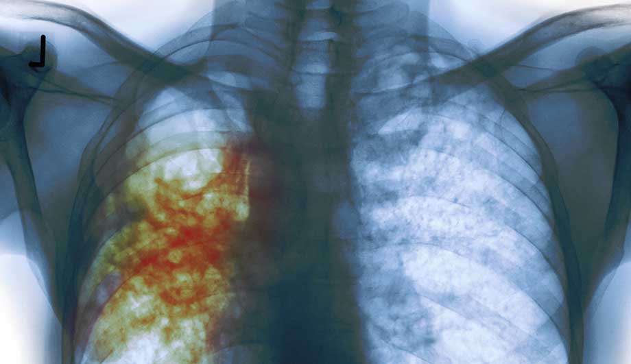 Туберкулез: симптомы, первые признаки на ранних стадиях