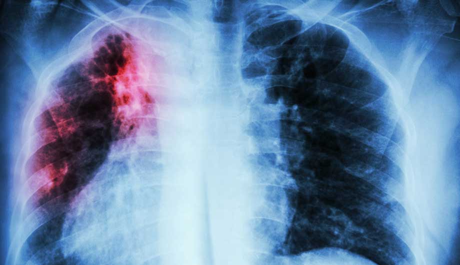 Туберкулез: симптомы, первые признаки у взрослых, терапия